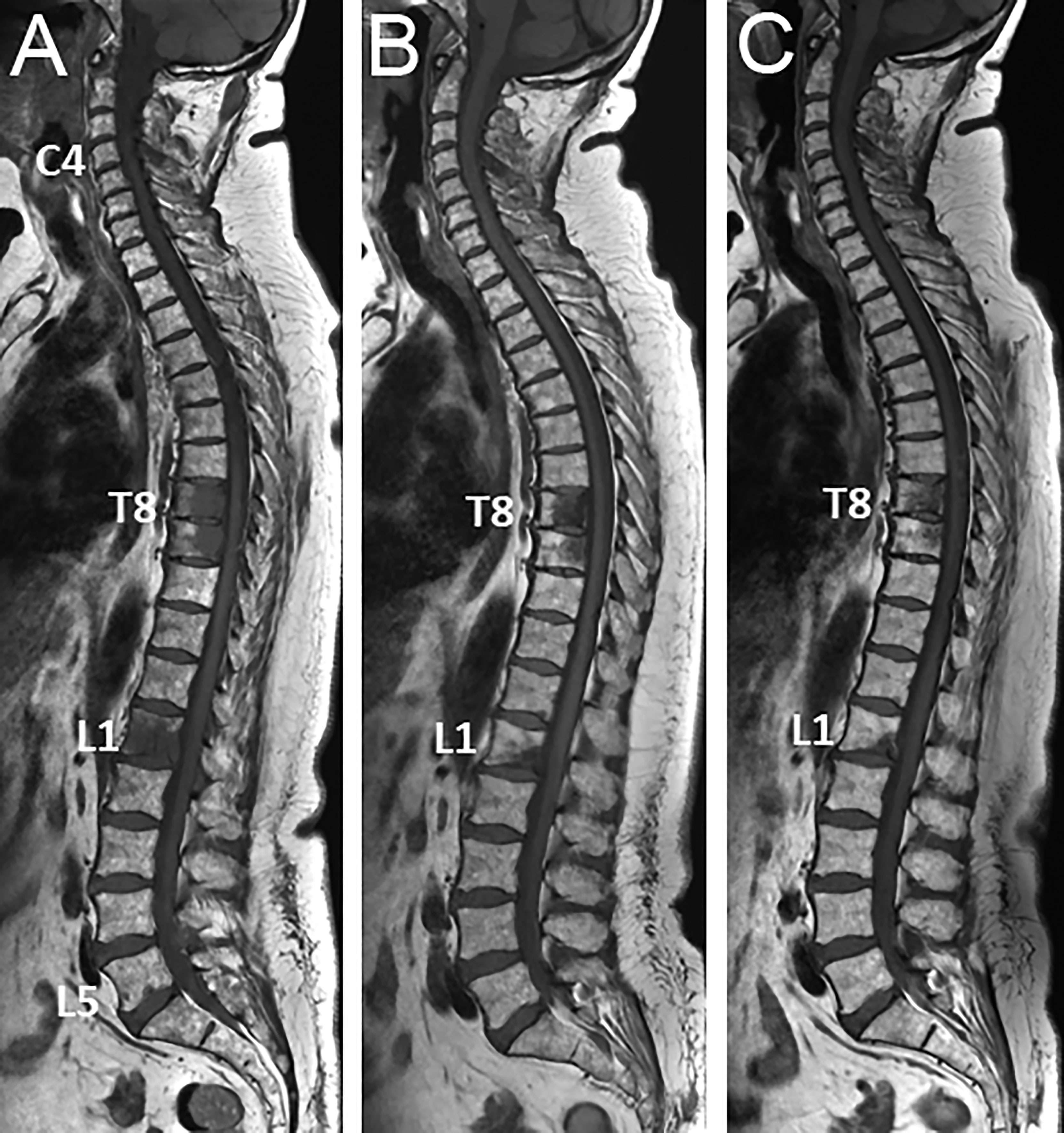 Frontiers Bone Metastases Are Measurable The Role Of Whole Body MRI 