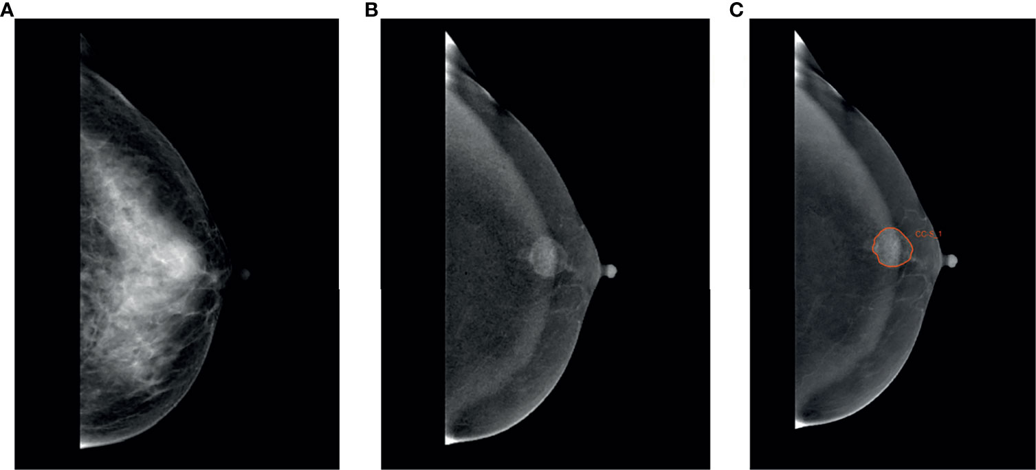 Frontiers Diagnostic Value Of Radiomics Analysis In Contrast Enhanced Spectral Mammography For 3651