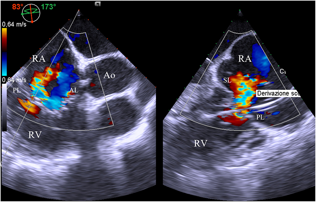 Frontiers  Transcatheter Tricuspid Valve Therapy: From Anatomy to