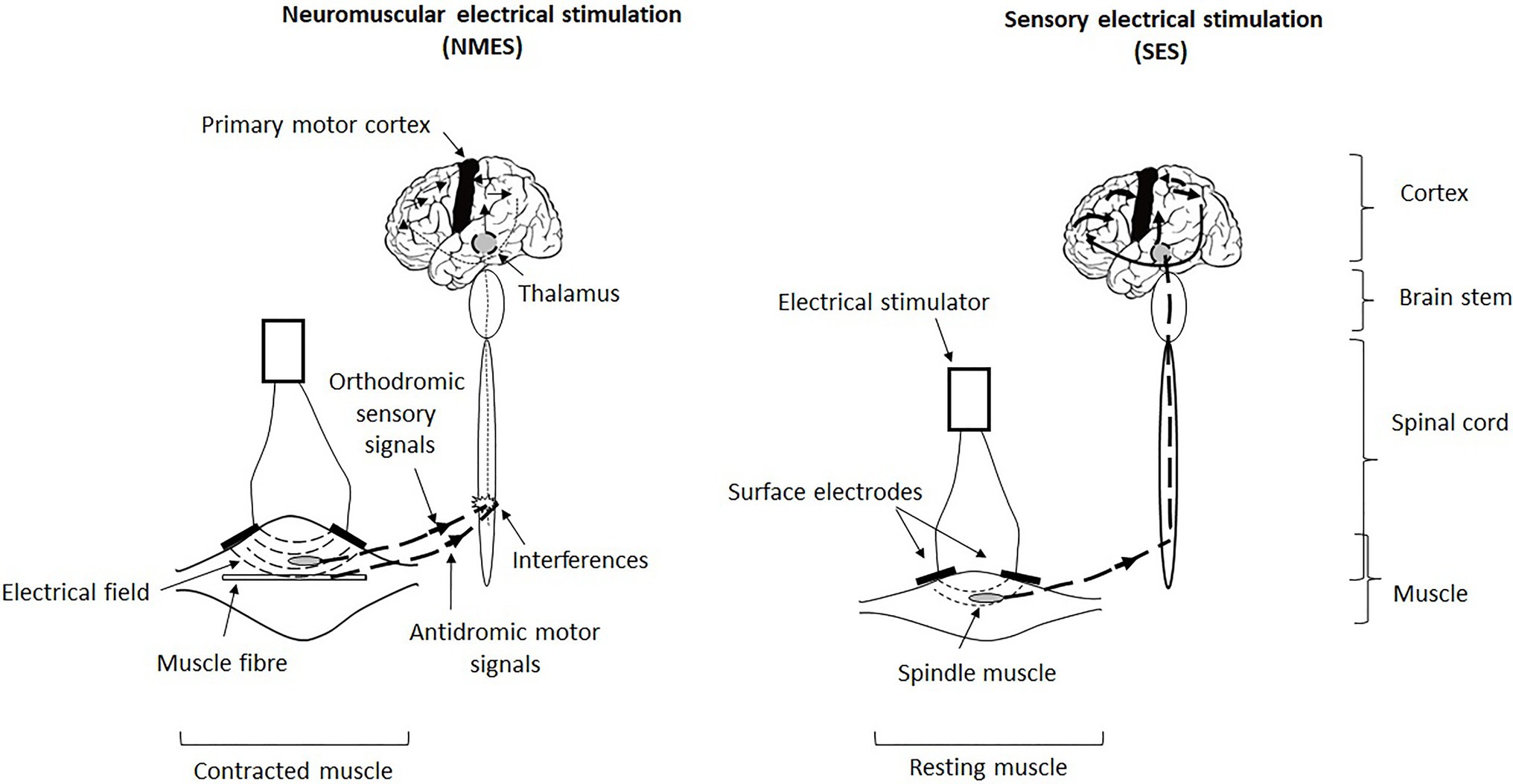 A Comparison of Multipath and Conventional Neuromuscular Electrical  Stimulation