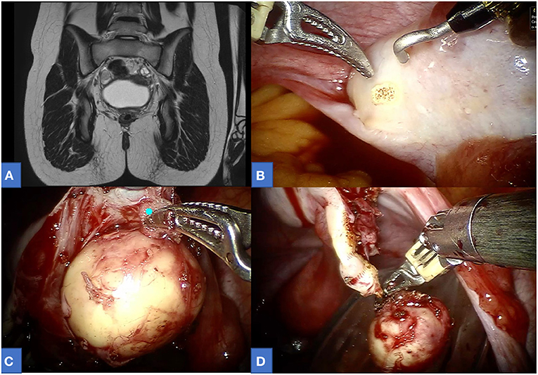 PDF) Ovarian Neoplastic Cysts found in Consecutive Cesarean Sections--Case  Report and Literature Review