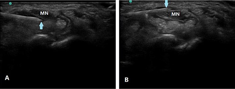 Cureus  Hydrodissection for the Treatment of Vascular Thoracic