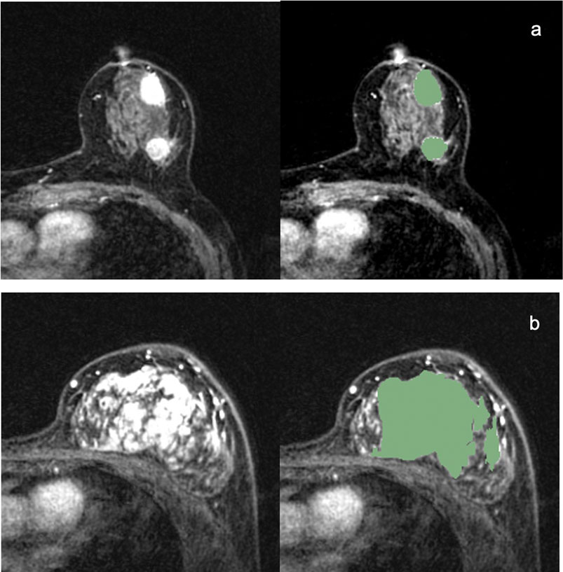 Frontiers  A Combined Nomogram Model to Predict Disease-free Survival in  Triple-Negative Breast Cancer Patients With Neoadjuvant Chemotherapy