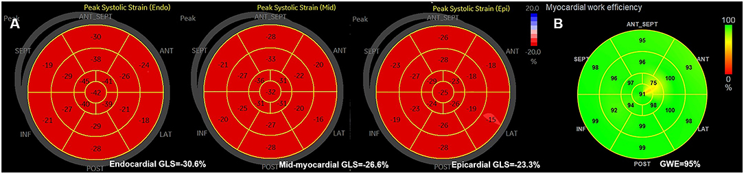 Examples of the longitudinal strain bull's eye plot in a patient with