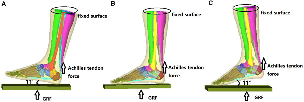 Effect of tendon stiffness on the generated force at the Achilles tendon -  3D finite element simulation of a human triceps surae muscle during  isometric contraction