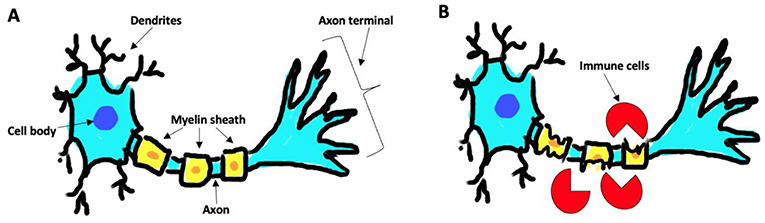 图1 - (A)一个健康的神经元，具有完整的髓鞘，可以有效地发送信号。