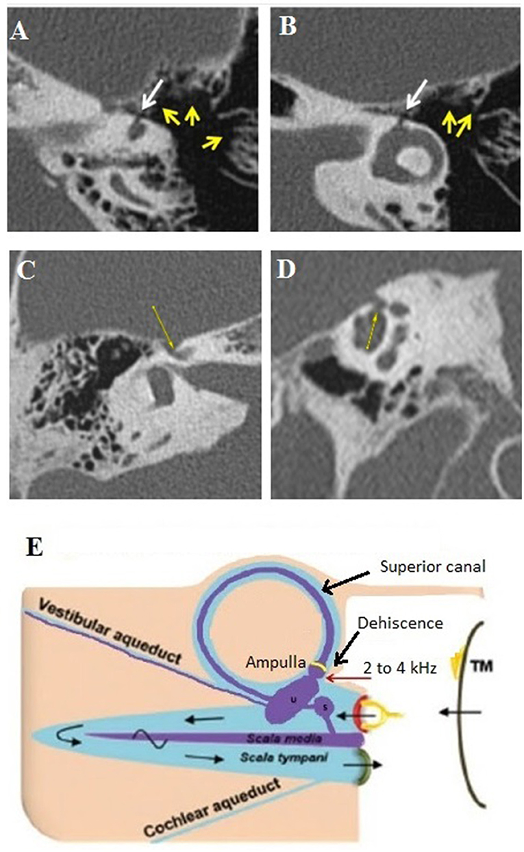 Frontiers  Audiovestibular Quantification in Rare Third Window