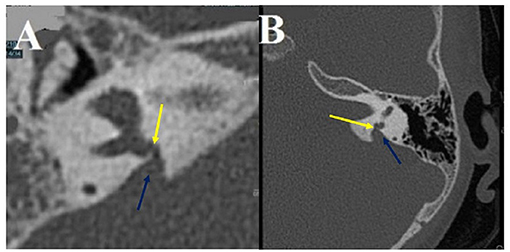 Frontiers  Audiovestibular Quantification in Rare Third Window