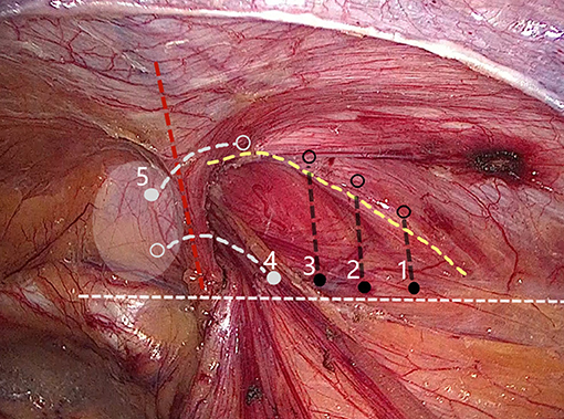 Laparoscopic repair of irreducible femoral hernia containing the