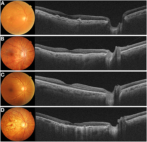 Frontiers | Choroidal Thickness Profile in Chorioretinal Diseases ...