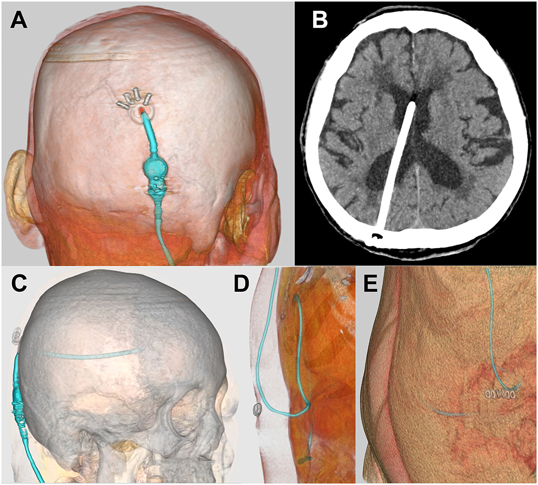 a) Ventriculoperitoneal shunt chamber along with the peritoneal