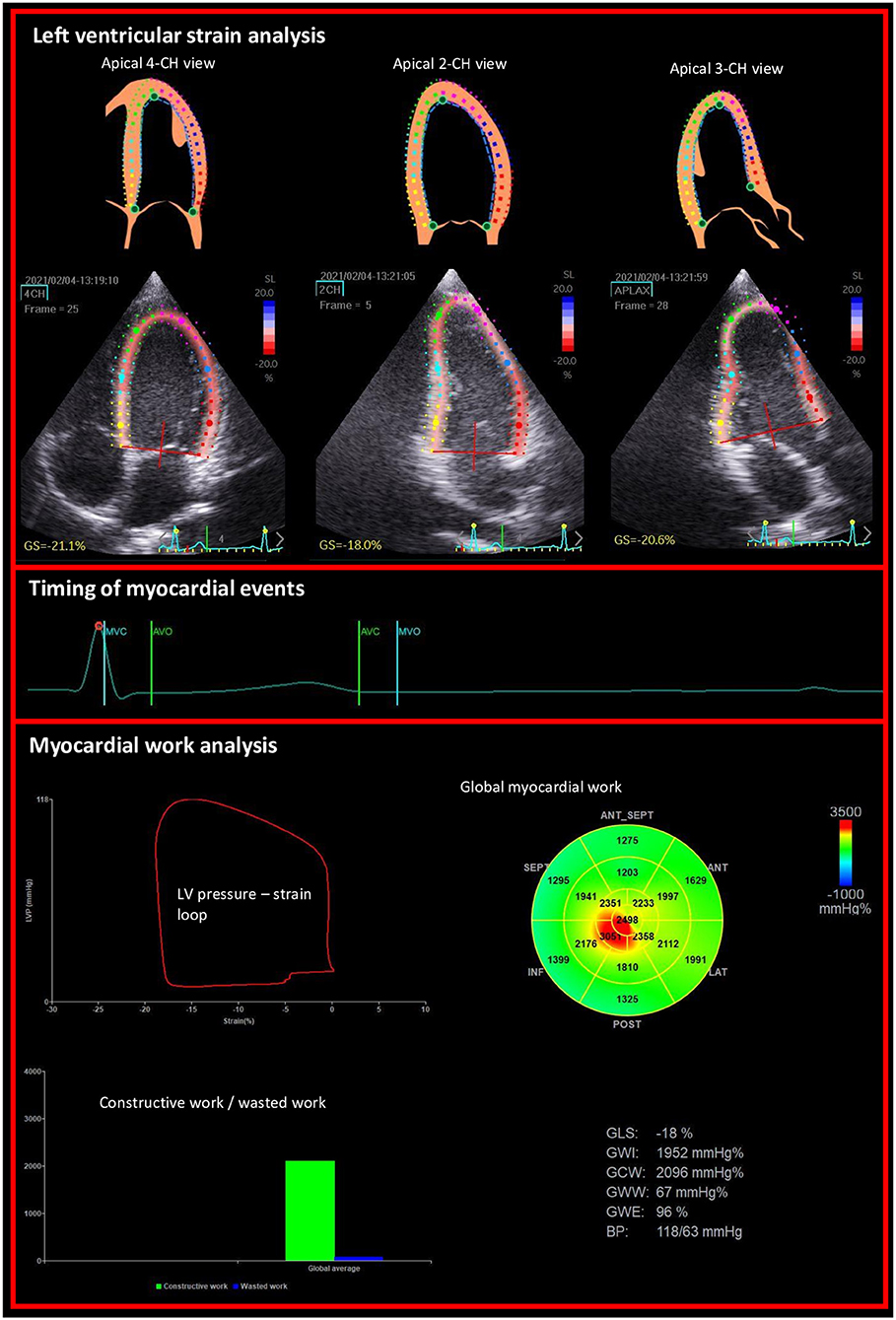 Left ventricular strain assessed by 2-dimensional speckle tracking