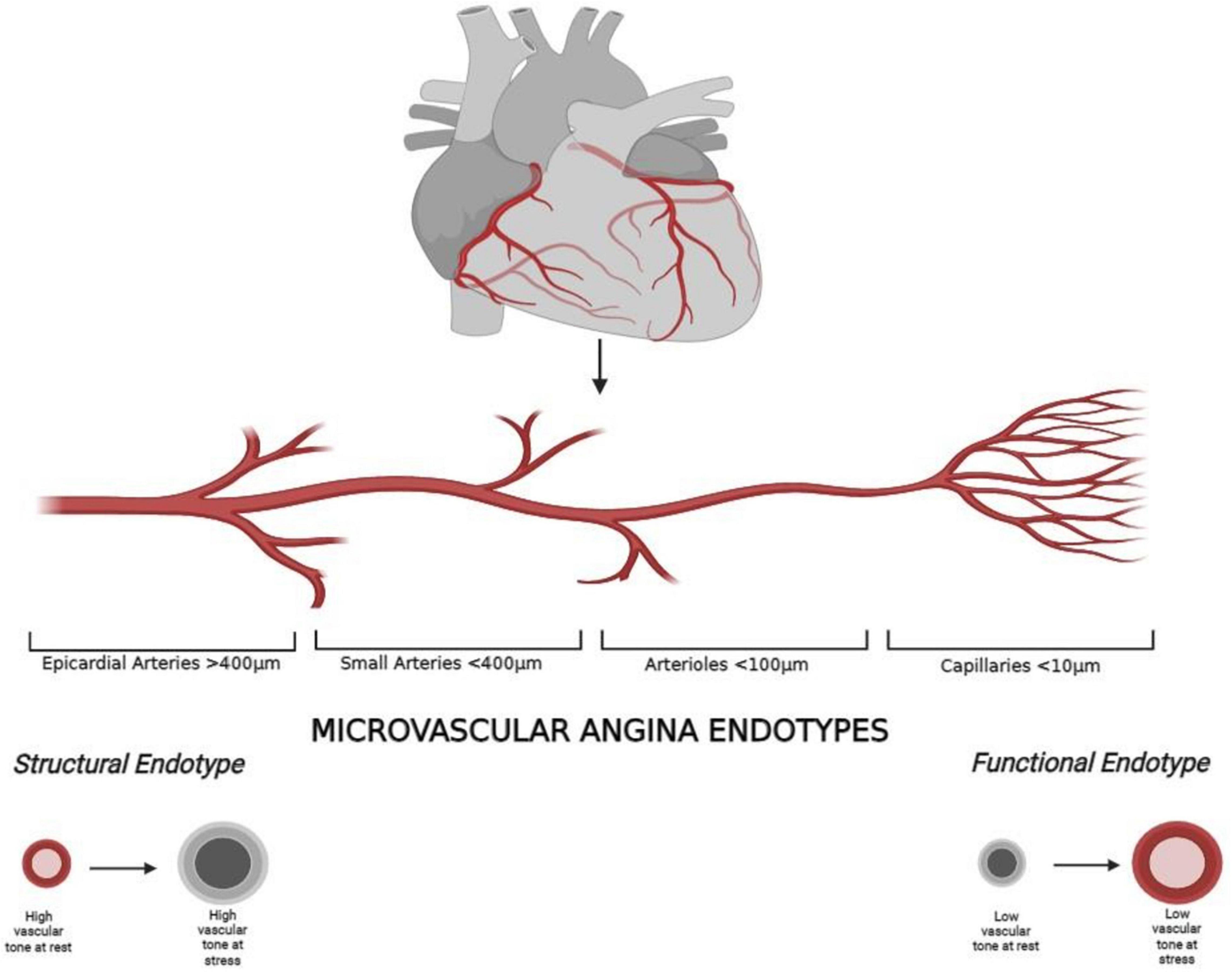 Frontiers Coronary Microvascular Angina A State of the Art Review