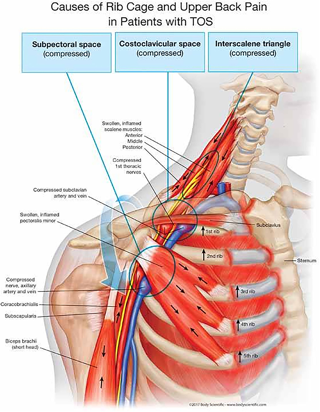 Thoracic Outlet Syndrome - Ryde Natural Health Clinic
