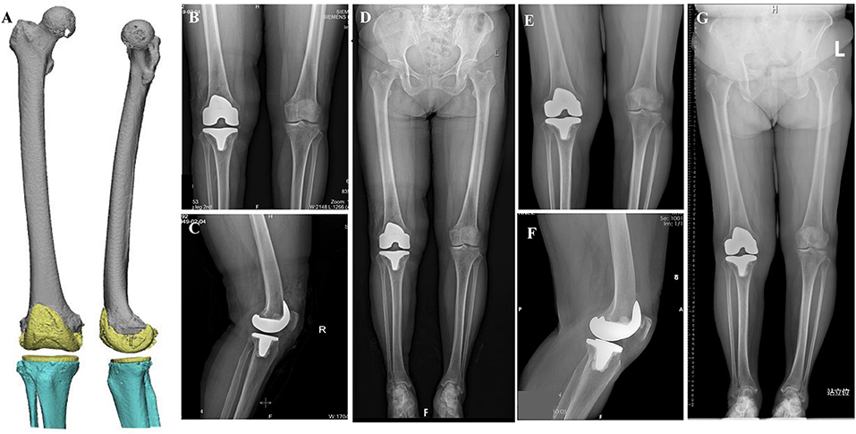 Frontiers | Mixed Reality Technology In Total Knee Arthroplasty: An ...