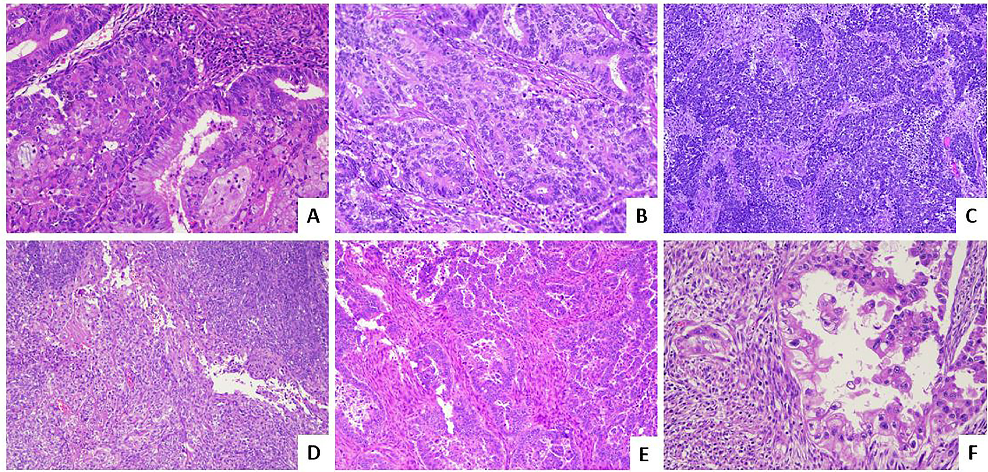  szak Amerika Kedv rt Villa Adenocarcinoma Endometrial Conventionalis 