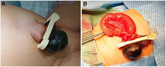 Frontiers  Case Report: 21 Cases of Umbilical Hernia Repair Using