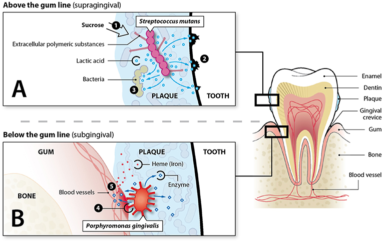 图1 -细菌生活上方和下方牙龈会损伤牙齿和牙龈。