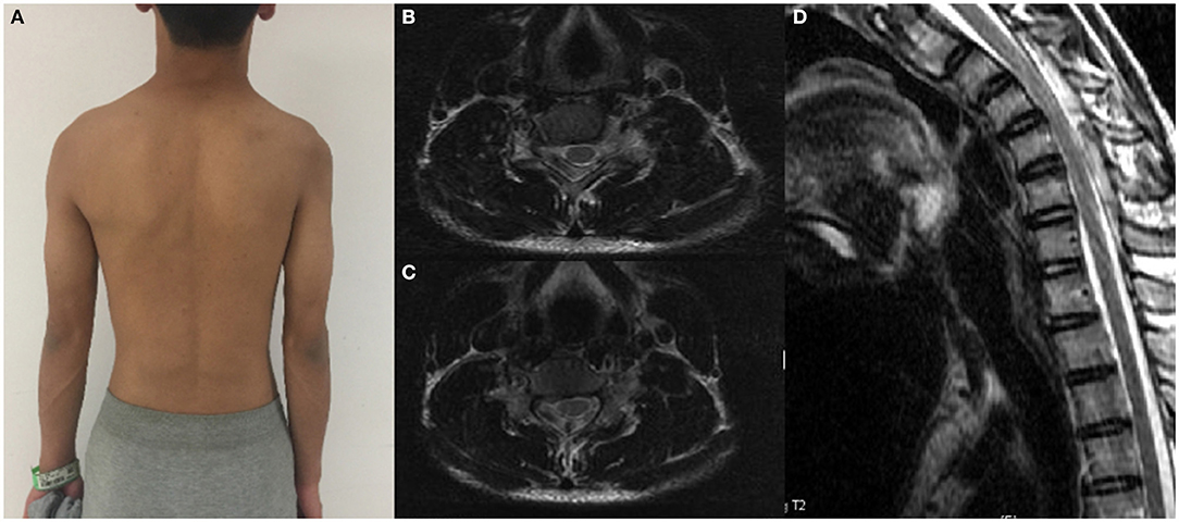 Upper Limb Reconstruction in Upper Motor Neuron Syndrome Clinic