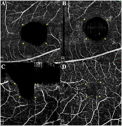 Frontiers The Role Of Internal Limiting Membrane Flap For Highly