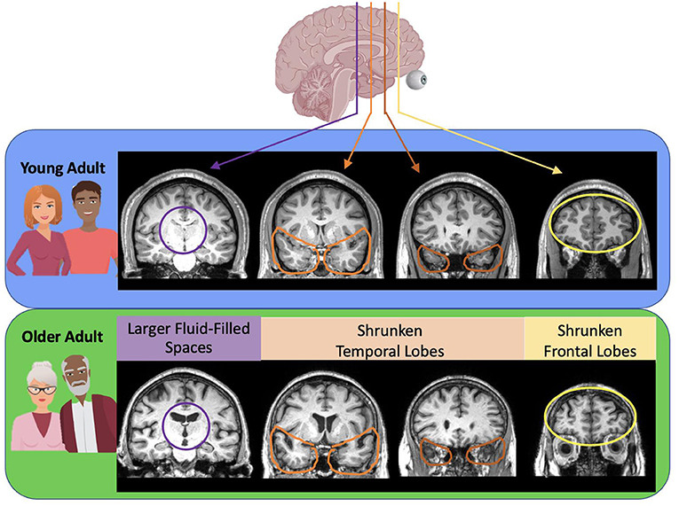 图1——年轻人和老年人的大脑核磁共振图像。