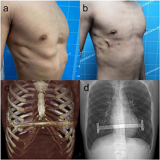 Frontiers A Modfied Nuss Procedure For Recurrent Pectus Excavatum Of Adults Surgery