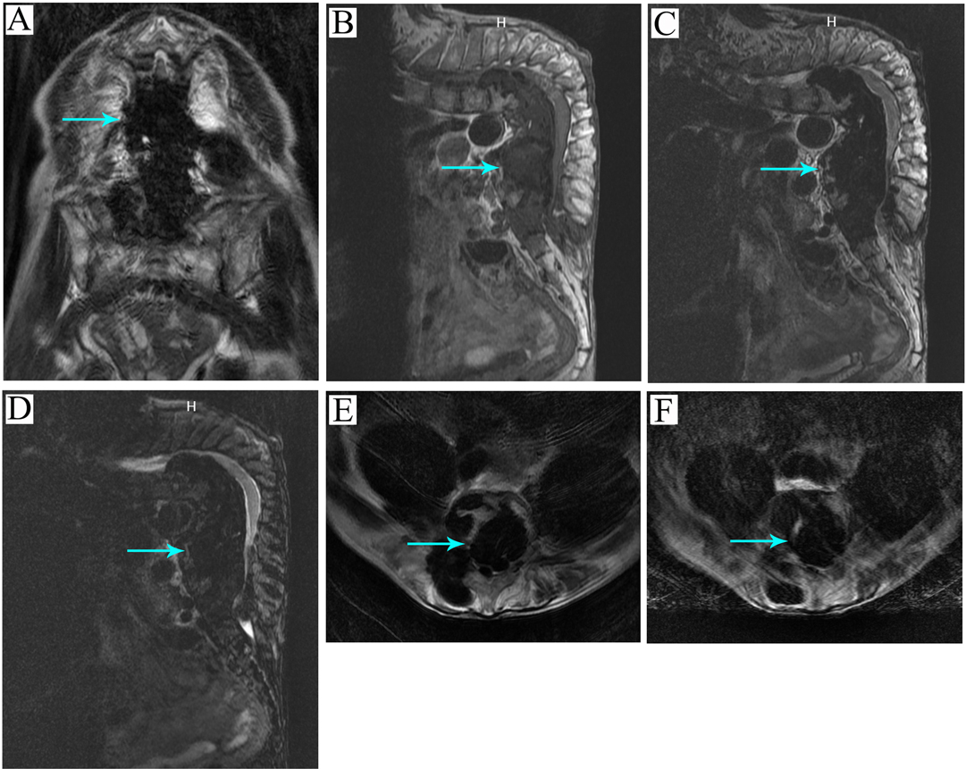 Frontiers  Multiple Spinal Tuberculosis with Severe Kyphosis: A Case Report