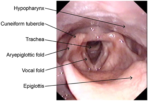 posterior commissure larynx