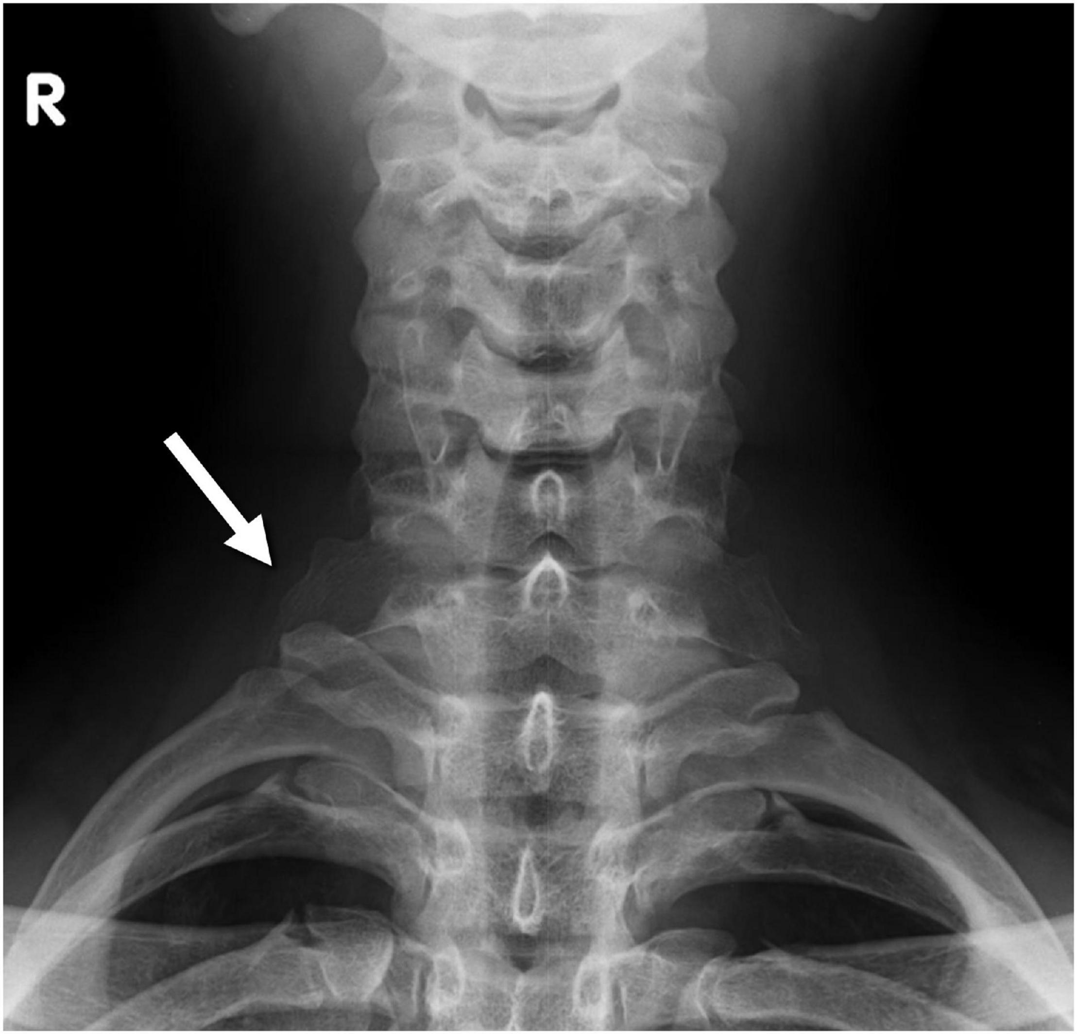 Typical thoracic vertebrae, Radiology Reference Article