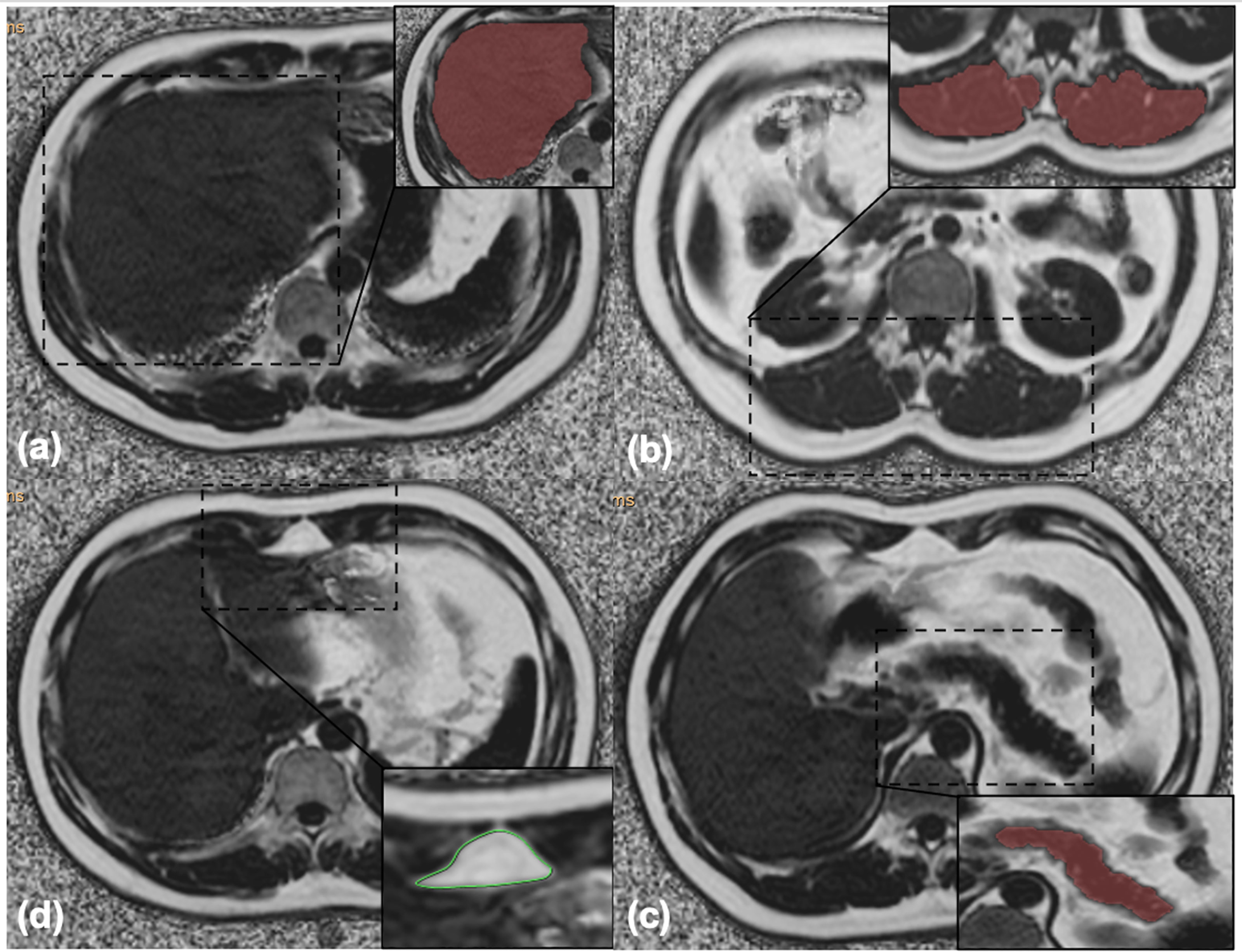 Frontiers | Magnetic Resonance Imaging Assessment of Abdominal 