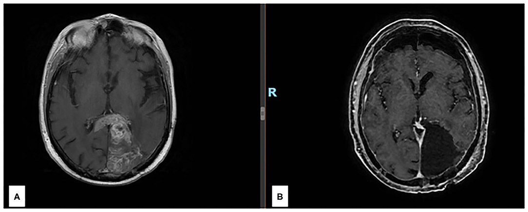 Figure 1. (A) Preoperative axial section of a T1 w MRI after gadolinium inj...