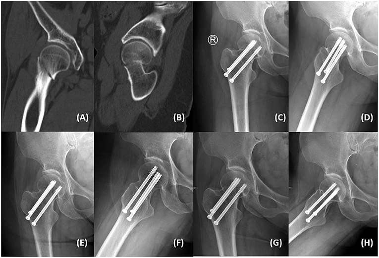 femoral neck fracture