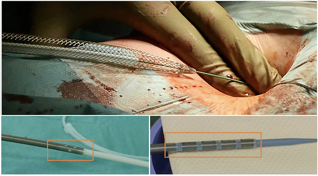 Frontiers  Percutaneous Venous Cannulation for Minimally Invasive Cardiac  Surgery: The Safest and Effective Technique Described Step-by-Step