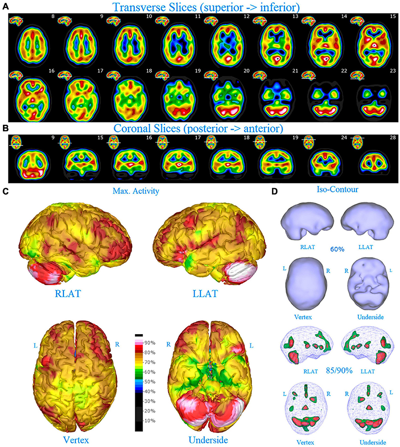 Frontiers | Increased Asymmetric Perfusion of the Cerebral
