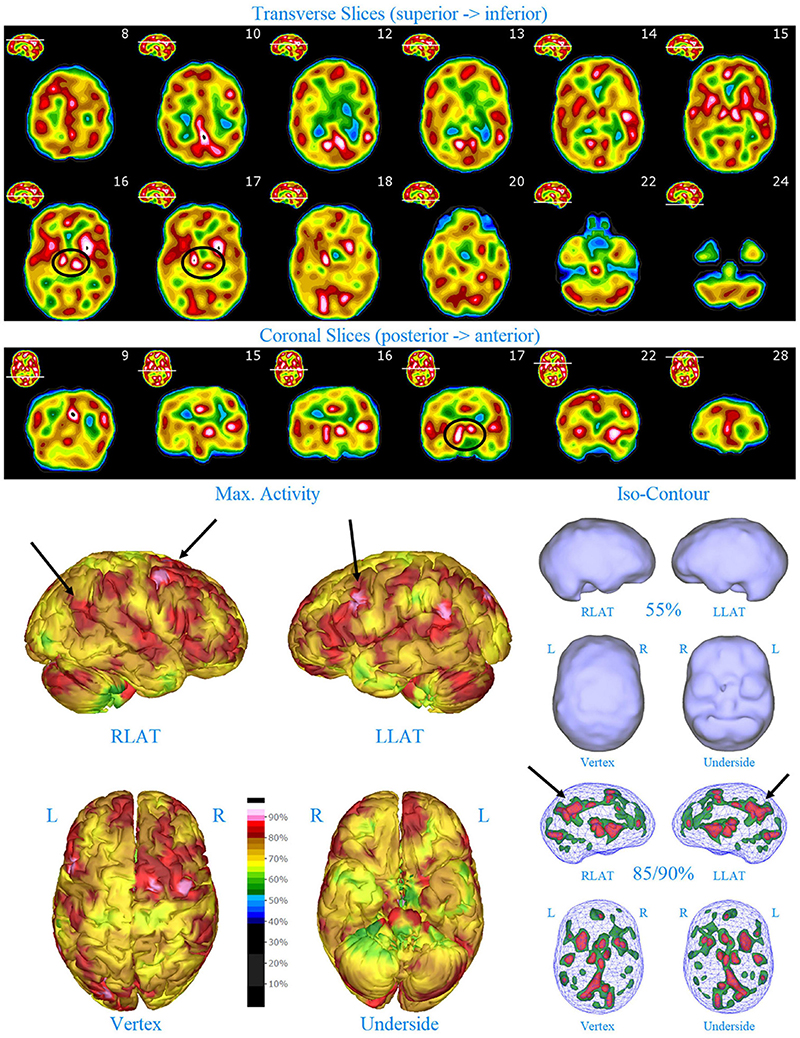 Frontiers  Increased Asymmetric Perfusion of the Cerebral Cortices and  Thalamus Indicates Individuals at Risk for Bipolar Disorder: A Family  Cohort Single Photon Emission Computed Tomography Neuroimaging Study