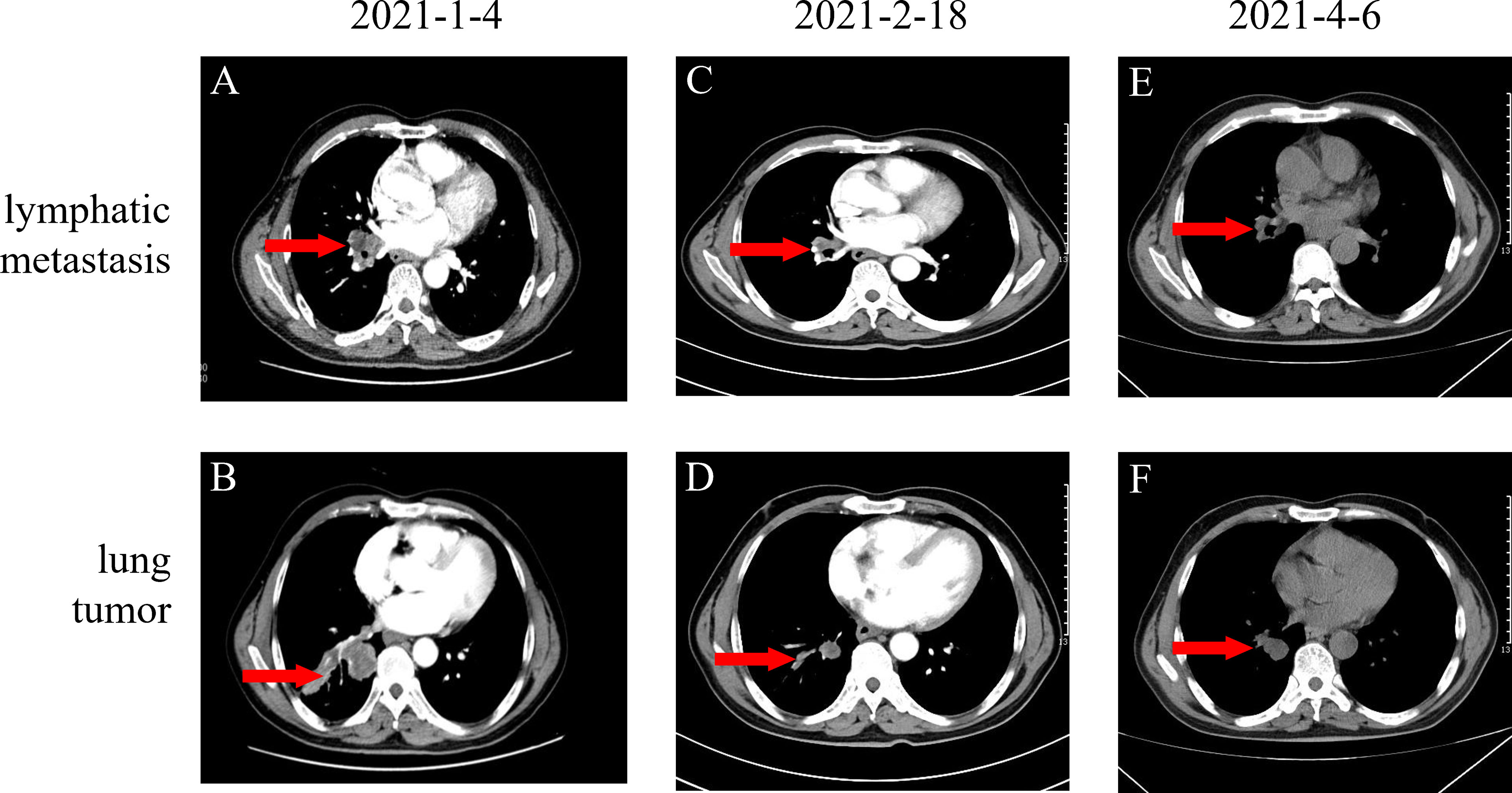 Frontiers Whole Process Treatment Of Combined Small Cell Lung Cancer 