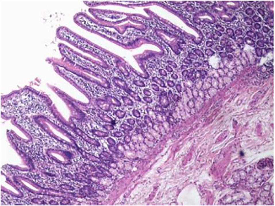 Frontiers | Intraluminal Diverticular Duodenal Duplication With ...