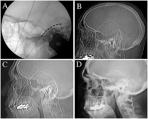 Frontiers  Case report: Use of peripheral nerve stimulation for treatment  of pain from vertebral plana fracture