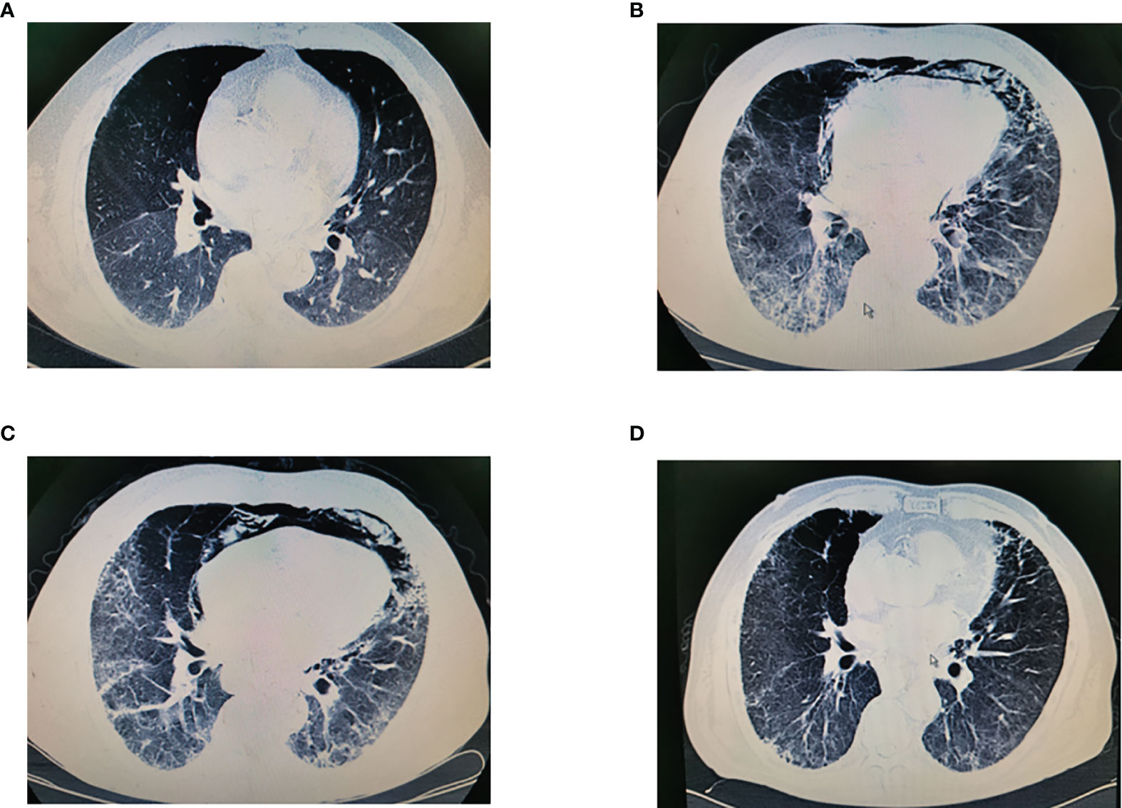 Does Preoperative Corticosteroid Administration Improve the Short-Term  Outcome of Minimally Invasive Esophagectomy for Esophageal Cancer? A  Propensity Score-Matched Analysis