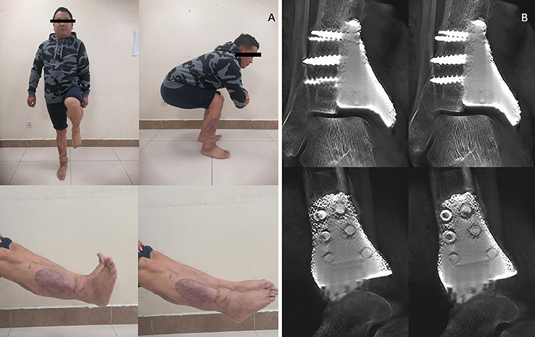 Analysis of bone transport for ankle arthrodesis as a limb salvage