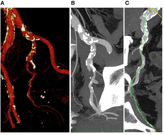 Frontiers Prevalence of Erectile Dysfunction in Patients With