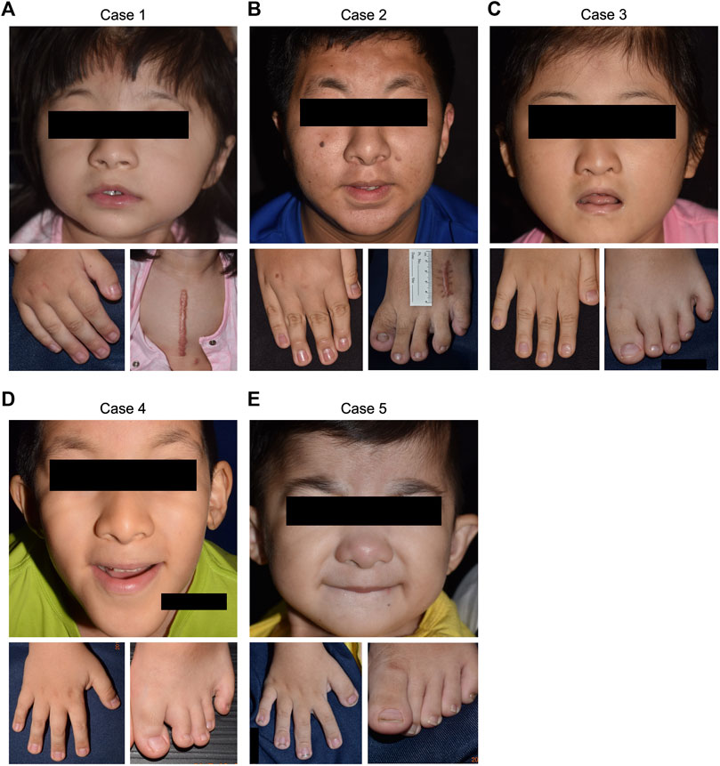 Rubinstein-Taybi Syndrome: A Complete Overview — DermNet
