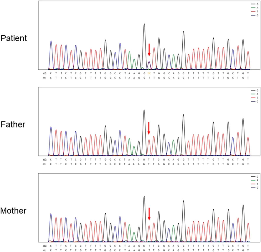 Frontiers Discovery Of Novel Variants On The Chd7 Gene A Case Series