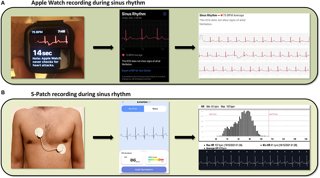 Understanding AFib: How to measure your own heart rate and rhythm - Scope