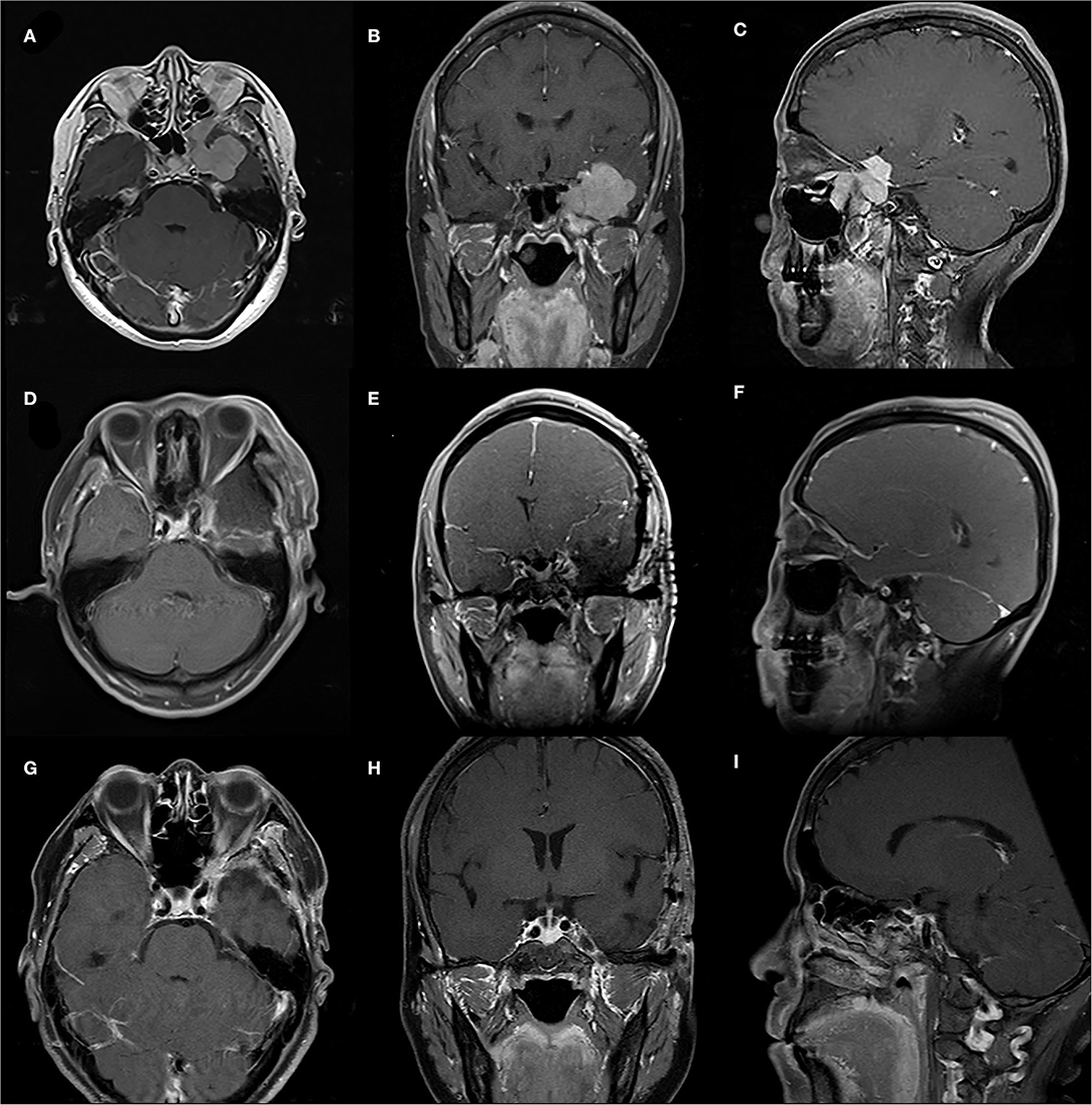 Frontiers Management Of Skull Base Meningiomas With Extracranial Extensions Clinical Features 