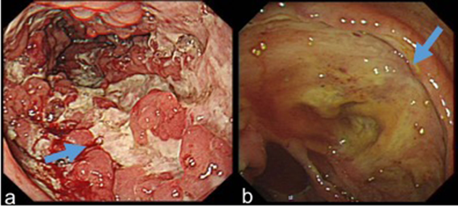 Crohn's Disease - Colorectal and Gastro Clinic, Colon Cancer, Colonoscopy, Endoscopy, Gallbladder