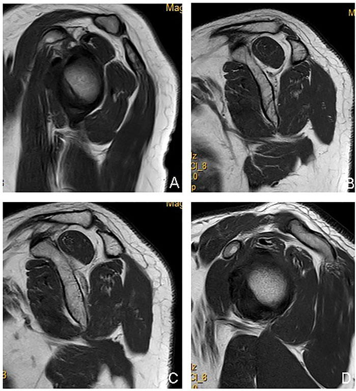 Frontiers  The correlation between types of posterior upper rotator cuff  tears and intramuscular fat infiltration based on magnetic resonance imaging:  A retrospective observational study