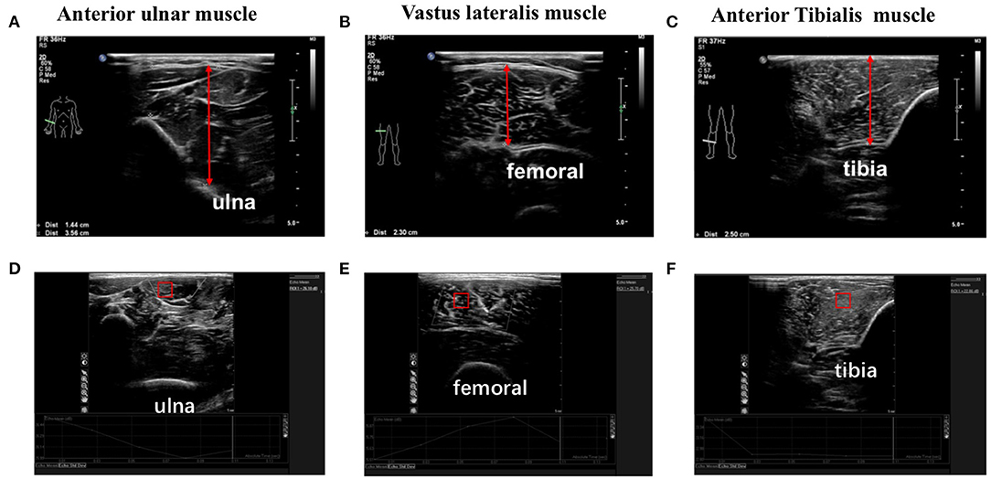 Frontiers | Application Of Muscle Thickness And Quality Measured By ...