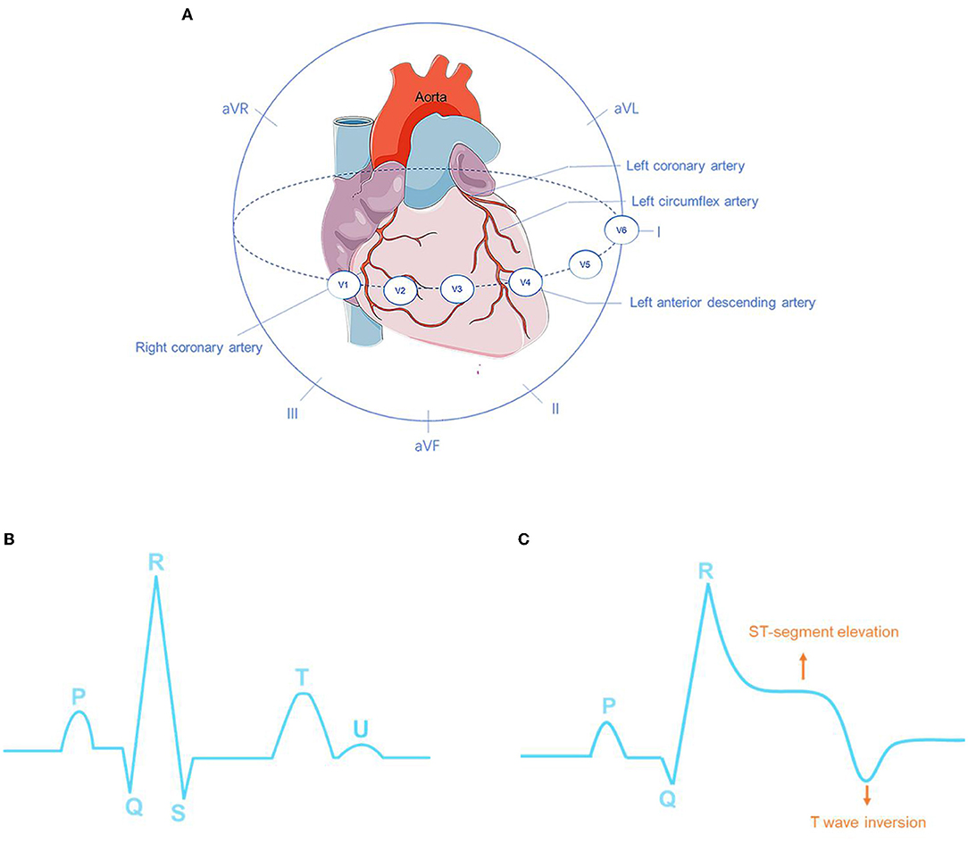 Frontiers  Deep Learning for Detecting and Locating Myocardial Infarction  by Electrocardiogram: A Literature Review
