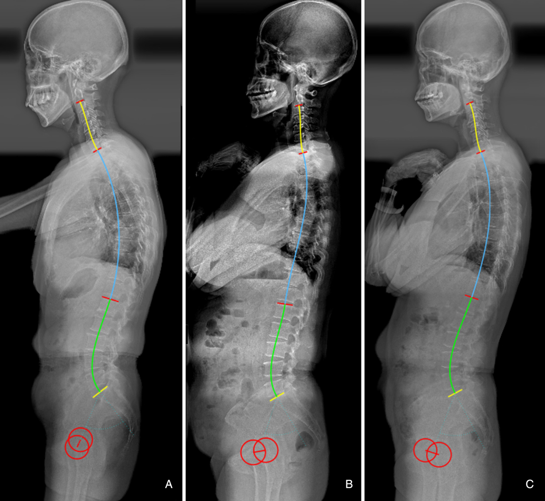 Frontiers  Load Distribution in the Lumbar Spine During Modeled  Compression Depends on Lordosis